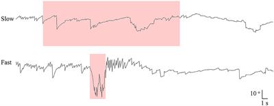 Positioning Velocity Matters in Central Paroxysmal Positional Vertigo: Implication for the Mechanism